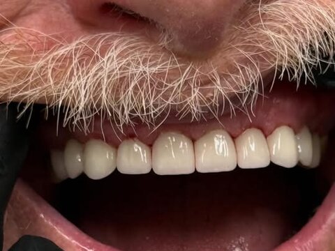 Patient's teeth after treatment at Elite Dental Care