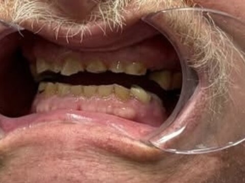 Patient's teeth before treatment at Elite Dental Care